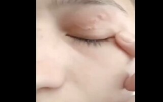 Doctors Remove 11-Centimeter Worm from Woman's Eyelid